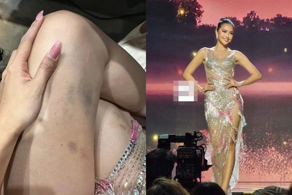 Ngọc Châu bầm dập cơ thể sau Miss Universe 2022-3