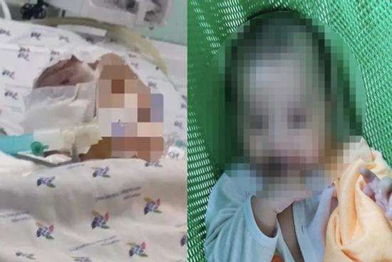 Bé 6 tháng tuổi bị bạo hành dập não thương tích tới 99%