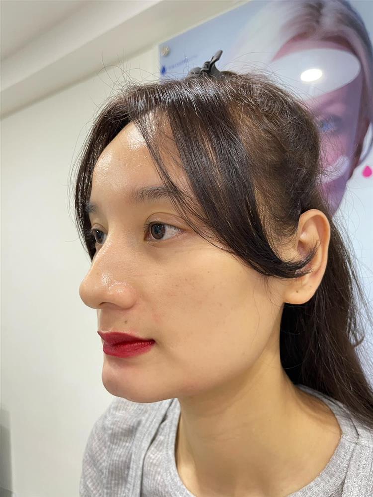 Lê Thúy tiêm filler cải thiện khuôn mặt bị ví như đàn ông-4