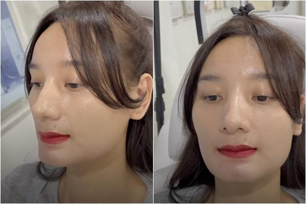 Lê Thúy tiêm filler cải thiện khuôn mặt bị ví như đàn ông-5