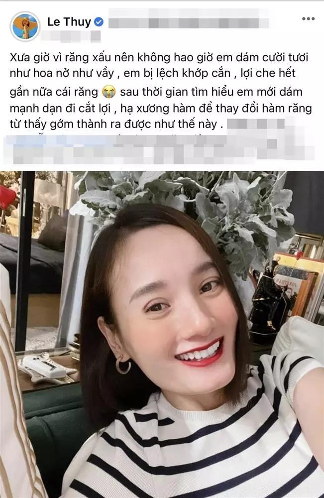 Lê Thúy tiêm filler cải thiện khuôn mặt bị ví như đàn ông-8