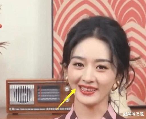 Triệu Lệ Dĩnh bị nghi lộ di chứng phẫu thuật thẩm mỹ-2