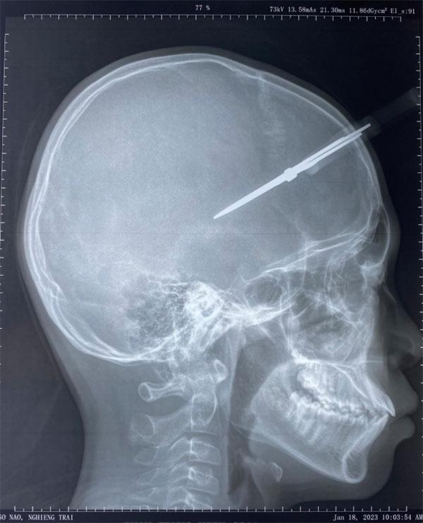 Học sinh bị kéo đâm thủng hộp sọ ngày giáp Tết-1