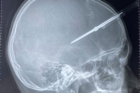 Học sinh bị kéo đâm thủng hộp sọ ngày giáp Tết