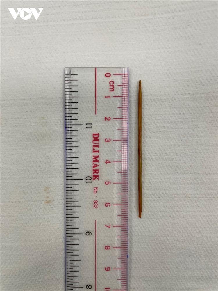 Bệnh nhân suýt mất mạng vì tăm tre xuyên tĩnh mạch chủ dưới-1