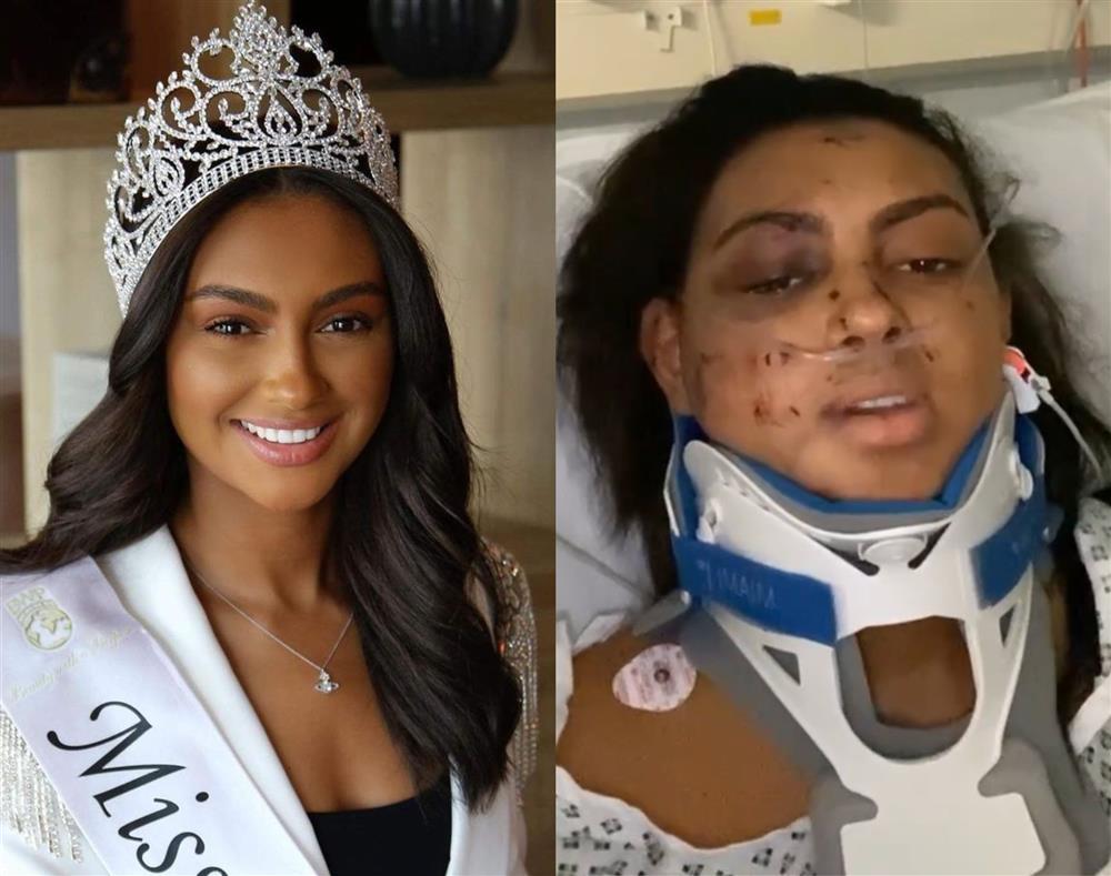 Hoa hậu Xứ Wales gãy xương cổ và xương chậu vì tai nạn-1