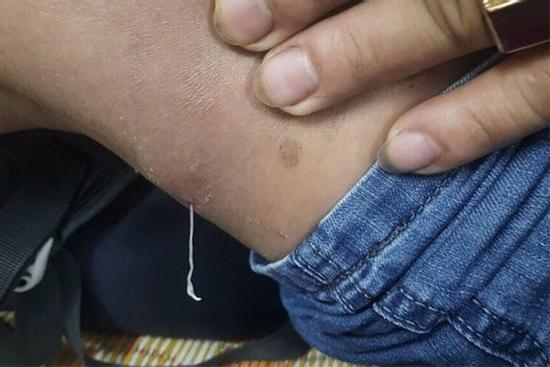 Người đàn ông kéo ra sinh vật lạ dưới da khi gãi ngứa