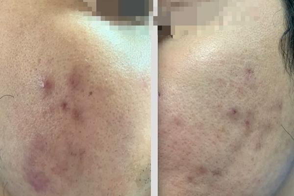 Nắm rõ những điều này trước khi tiêm meso, chị em sẽ không lo u hạt-6