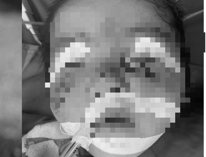 Sang hàng xóm chơi, bé 3 tuổi bị chó cắn rách mặt-1