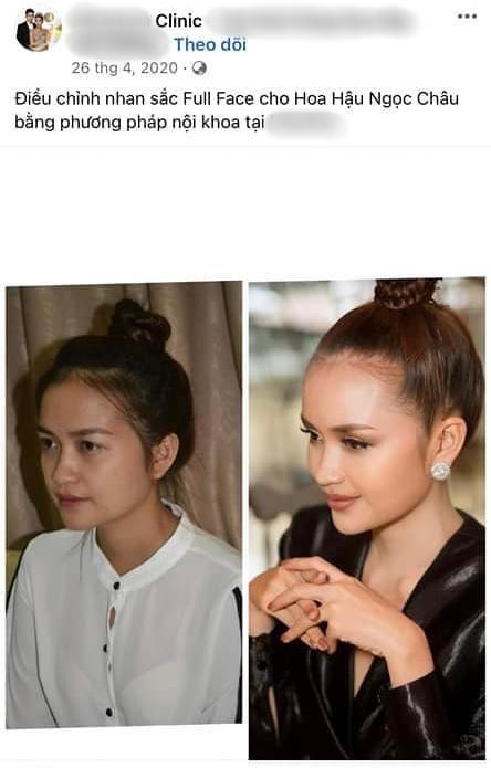 Ngọc Châu lộ ảnh sửa toàn bộ dù nói thời gian đâu phẫu thuật-3