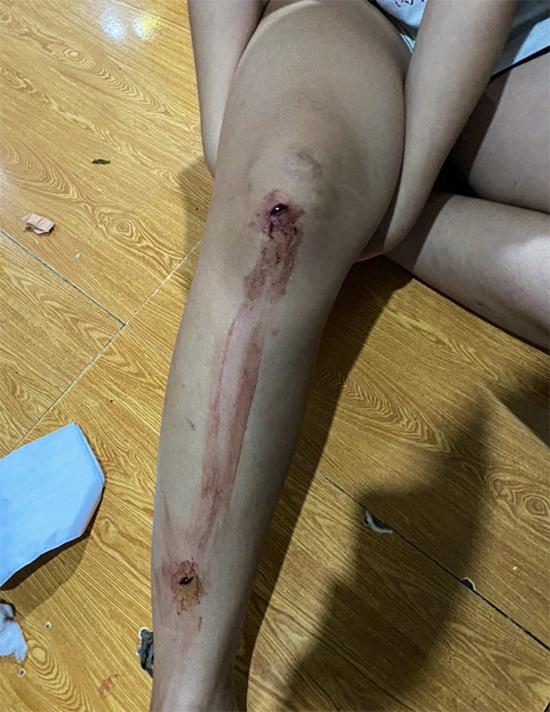 Đang phơi quần áo, 2 chị em bị kẻ lạ mặt nổ súng bắn vào người-1