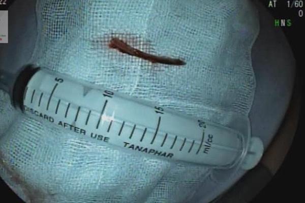 Mời thầy cúng làm phép chữa hóc, cô gái suýt thủng thực quản-2