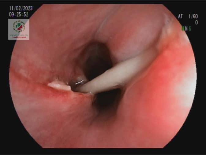 Mời thầy cúng làm phép chữa hóc, cô gái suýt thủng thực quản-1
