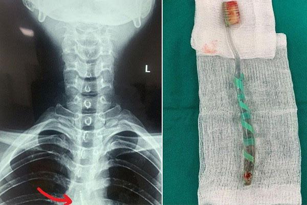 Ăn thịt gà bị mắc, thanh niên nuốt luôn bàn chải đánh răng khi đang gỡ-1
