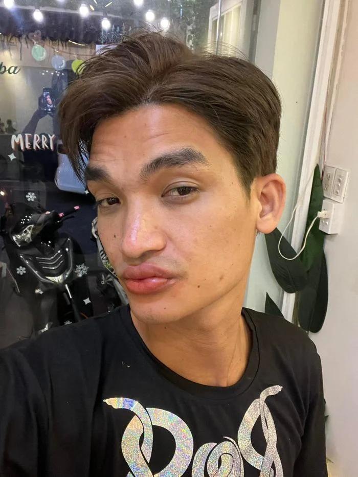 Mạc Văn Khoa không khép được mồm vì xăm môi khử thâm-1