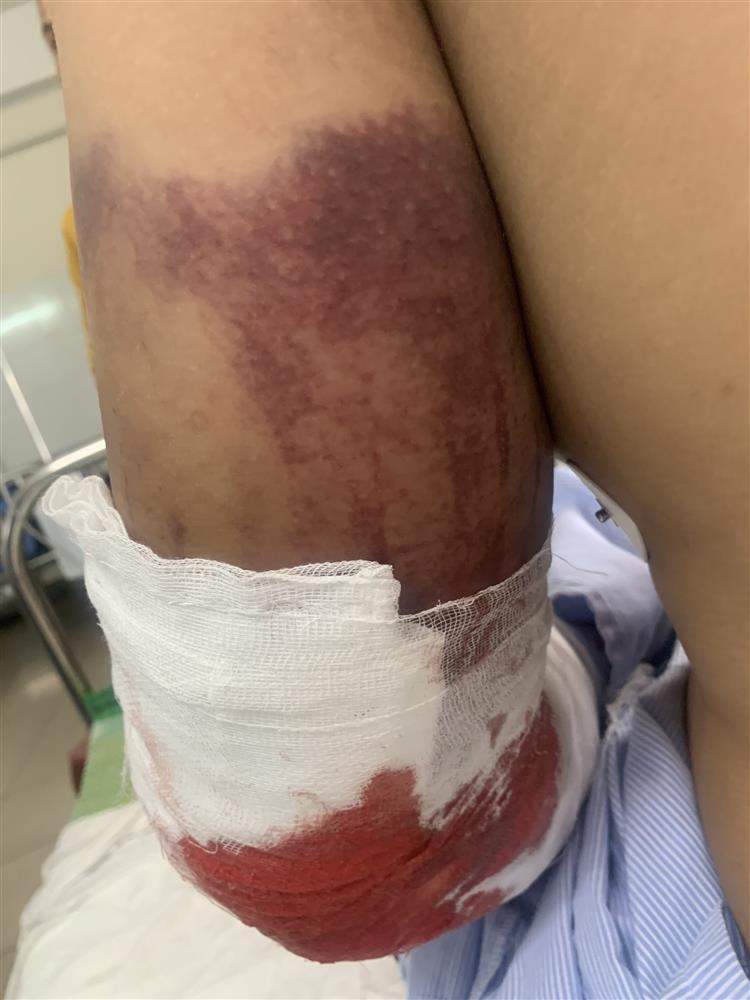 Shipper bị đánh gãy 2 tay: Sắp thi bằng lái B2 thì gặp nạn-3