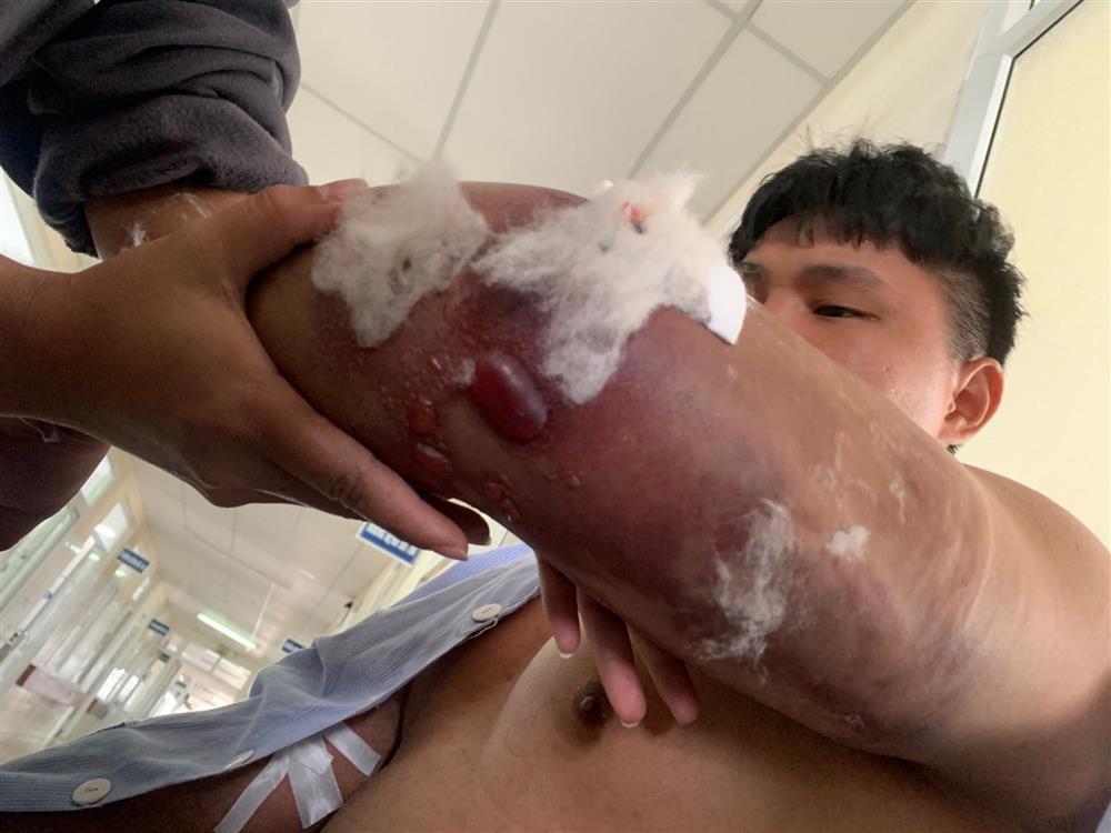 Shipper bị đánh gãy 2 tay: Sắp thi bằng lái B2 thì gặp nạn-2