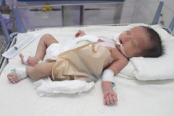 Sinh con tại nhà, 1 tuần sau mới phát hiện trẻ không có hậu môn-1