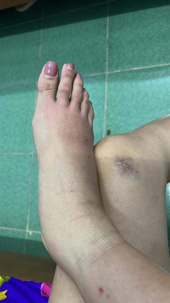 Võ Hoàng Yến bầm dập cơ thể, nhìn mà xót đôi chân bạc tỷ-2