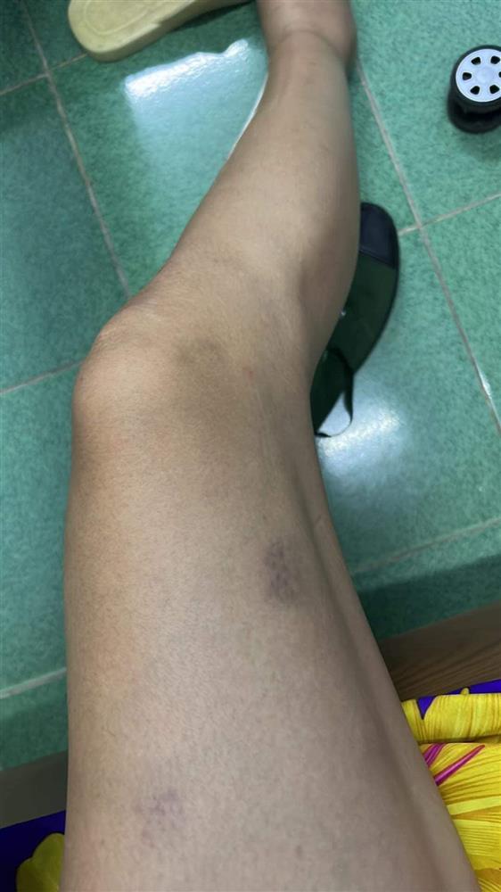 Võ Hoàng Yến bầm dập cơ thể, nhìn mà xót đôi chân bạc tỷ-3