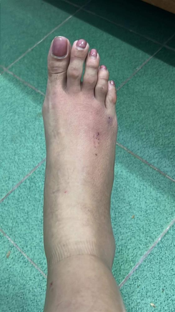 Võ Hoàng Yến bầm dập cơ thể, nhìn mà xót đôi chân bạc tỷ-4