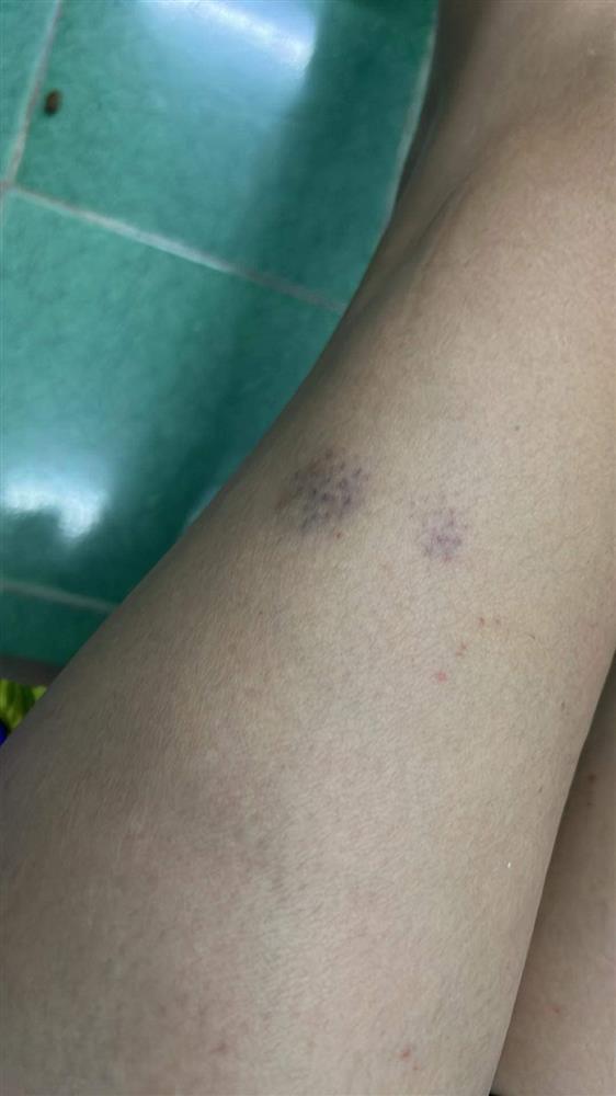 Võ Hoàng Yến bầm dập cơ thể, nhìn mà xót đôi chân bạc tỷ-5