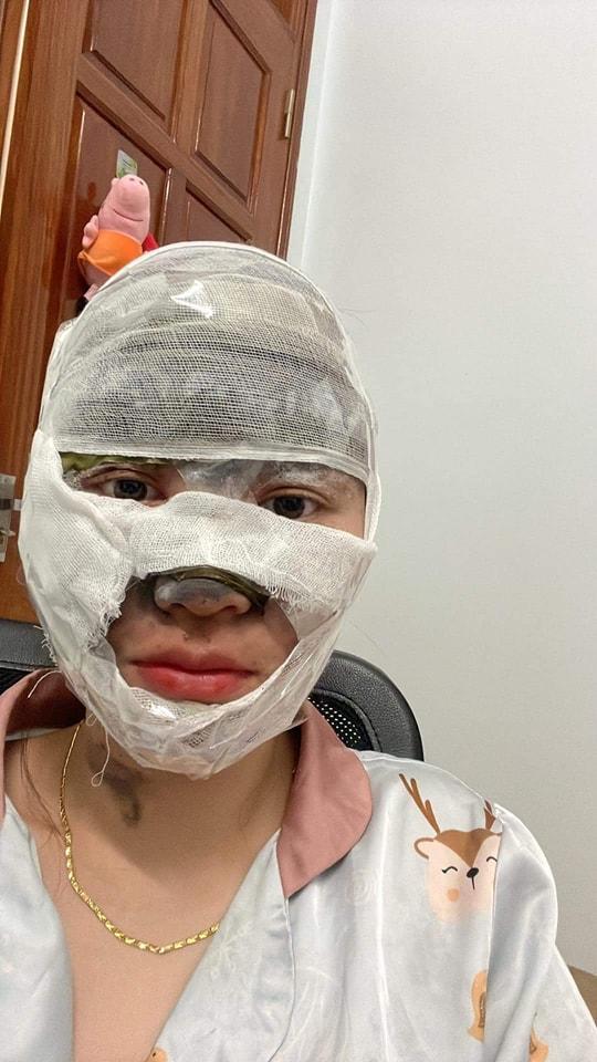 Dùng bơm điện bơm đây bóng bay, cô gái bị nổ bỏng mặt-3