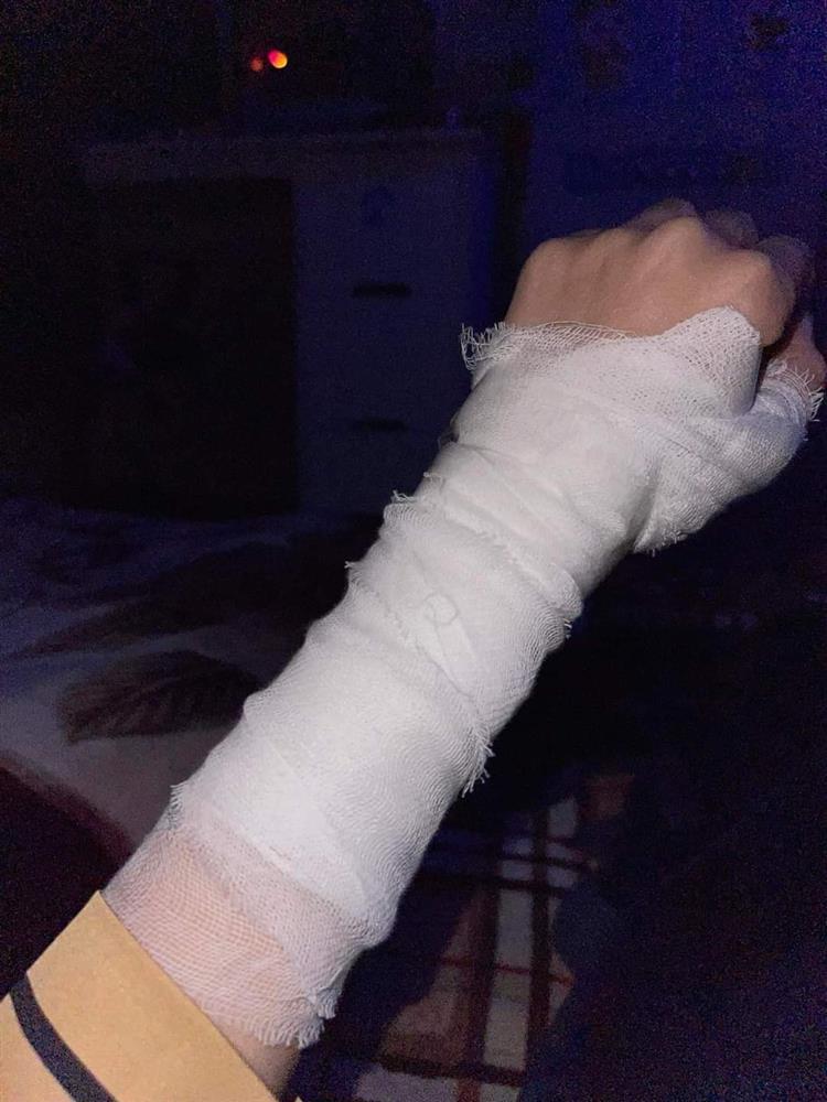 Dùng bơm điện bơm đây bóng bay, cô gái bị nổ bỏng mặt-4