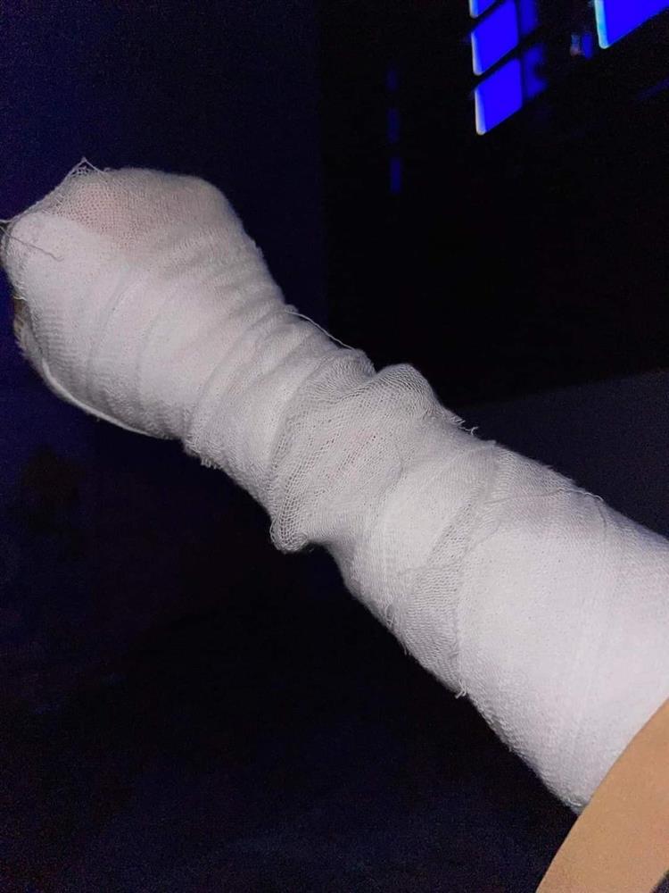 Dùng bơm điện bơm đây bóng bay, cô gái bị nổ bỏng mặt-5