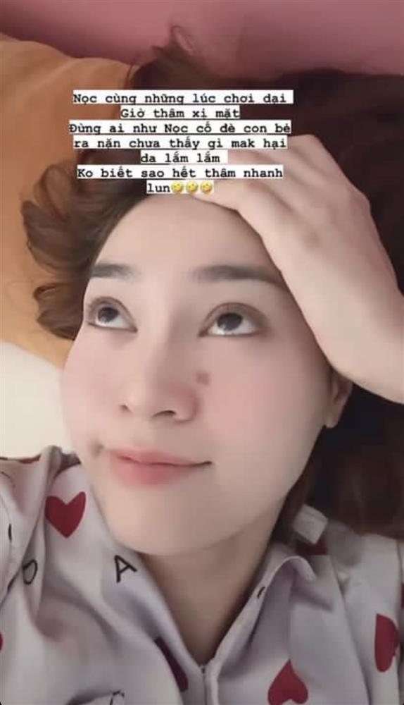 Ninh Dương Lan Ngọc trả giá vì thói quen cực xấu khi bị mụn-1