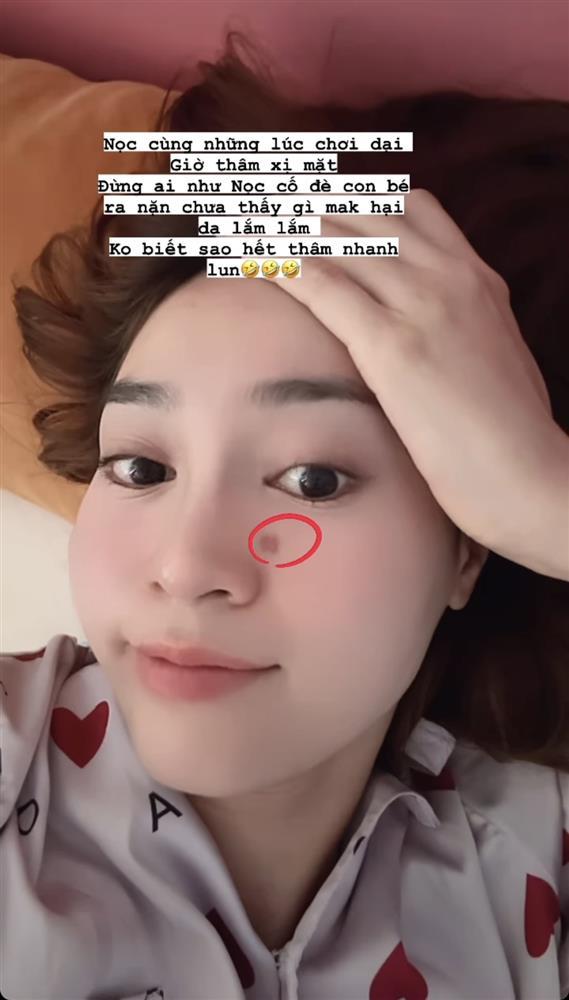 Ninh Dương Lan Ngọc trả giá vì thói quen cực xấu khi bị mụn-2