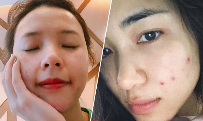 Ninh Dương Lan Ngọc trả giá vì thói quen cực xấu khi bị mụn-5
