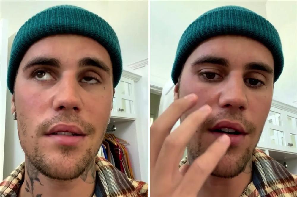 Justin Bieber hủy toàn bộ chuyến lưu diễn còn lại vì hậu chứng liệt nửa mặt-3