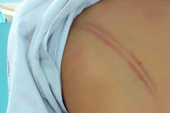 Chỉ đạo ‘nóng’ vụ mẹ kế đánh con chồng hàng chục vết bầm tím