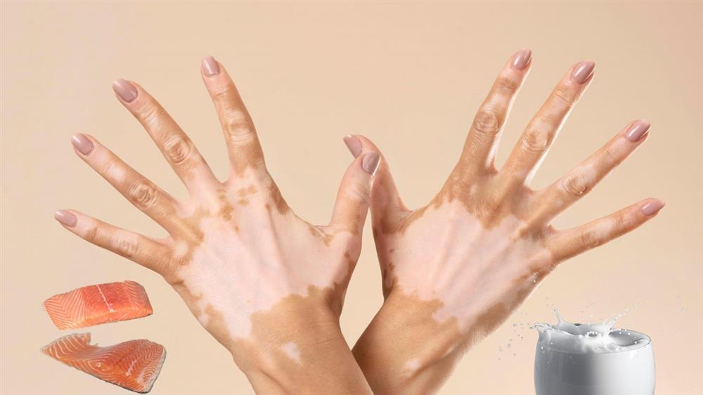 Uống sữa sau khi ăn cá có gây bệnh ngoài da?-1