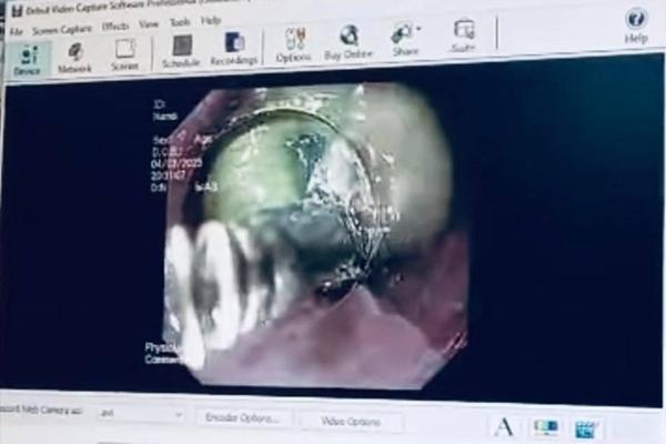 Sản phụ suýt mất mạng vì nuốt túi mật lợn-1