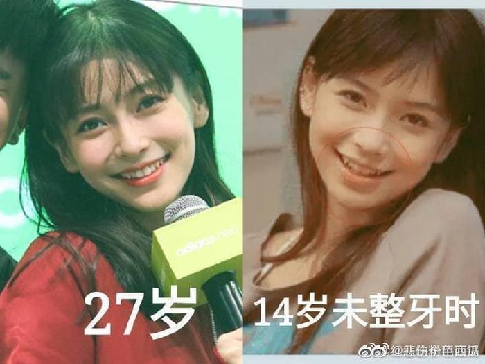 Angelababy sở hữu nhan sắc bao năm không đổi nhờ tip niềng răng đặc biệt-3