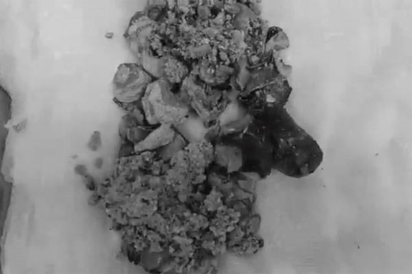 Sỏi thận khổng lồ dài 20cm sau 50 năm tồn tại trong cơ thể-1