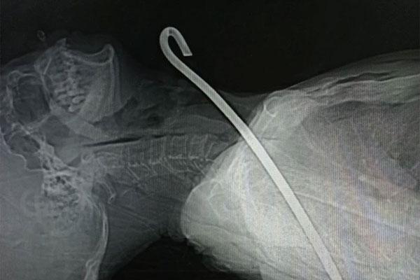 Người đàn ông bị thanh sắt dài 30cm đâm xuyên cổ-1