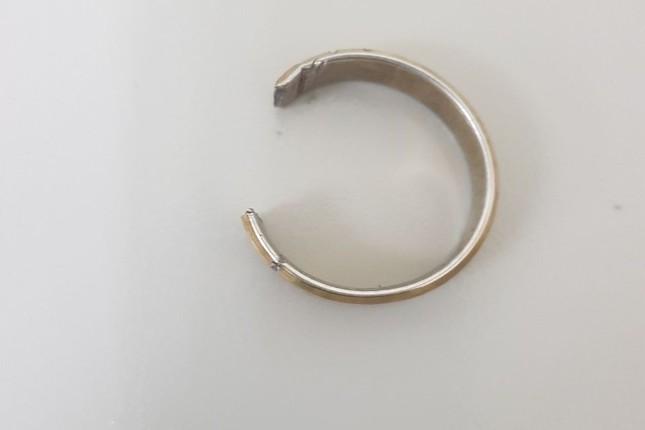 Nam thanh niên 27 tuổi suýt hoại tử dương vật vì đeo nhẫn tìm cảm giác lạ-2