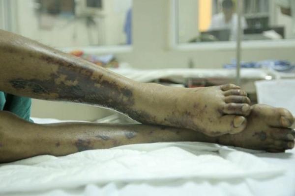 Người đàn ông nhiễm liên cầu khuẩn lợn nguy kịch dù không ăn tiết canh-1