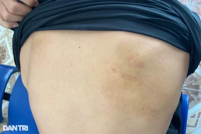 Nam sinh bị bạn hành hung tới giờ vẫn sợ hãi, không biết vì sao ăn đòn-2