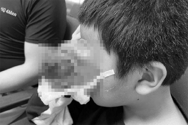 Nhiều nơi từ chối mổ, bé trai đau đơn vì khối u khổng lồ ở mắt-1