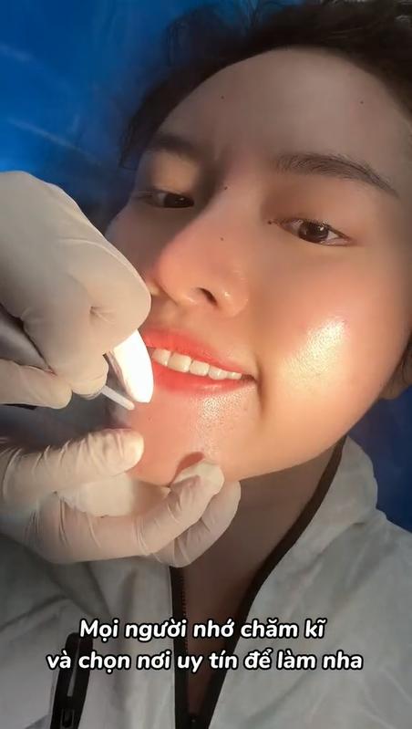 Thanh Thanh Huyền tẩy hàng loạt nốt ruồi và tàn nhang hậu Miss Charm-2