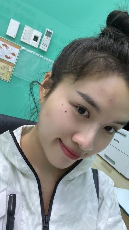 Thanh Thanh Huyền tẩy hàng loạt nốt ruồi và tàn nhang hậu Miss Charm-3