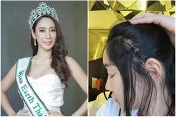 Hoa hậu Thái Lan công khai ảnh chụp vết sẹo lớn sau thẩm mỹ