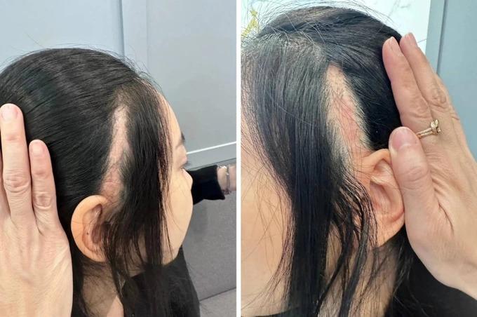 Hoa hậu Thái Lan công khai ảnh chụp vết sẹo lớn sau thẩm mỹ-2