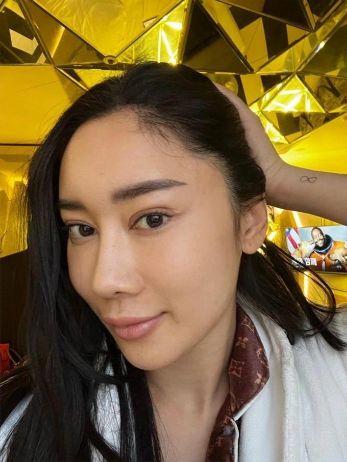 Hoa hậu Thái Lan công khai ảnh chụp vết sẹo lớn sau thẩm mỹ-4