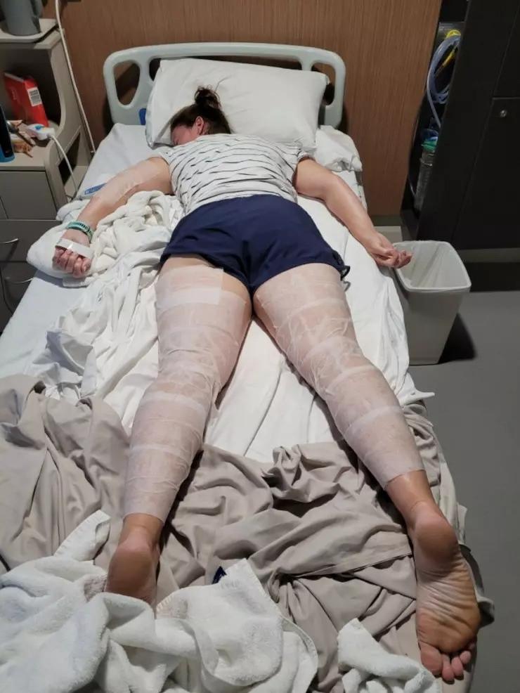 Nữ du khách đau đớn suốt 9 tháng do ngã vào loài cây cực độc-3