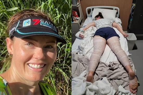 Nữ du khách đau đớn suốt 9 tháng do ngã vào loài cây cực độc